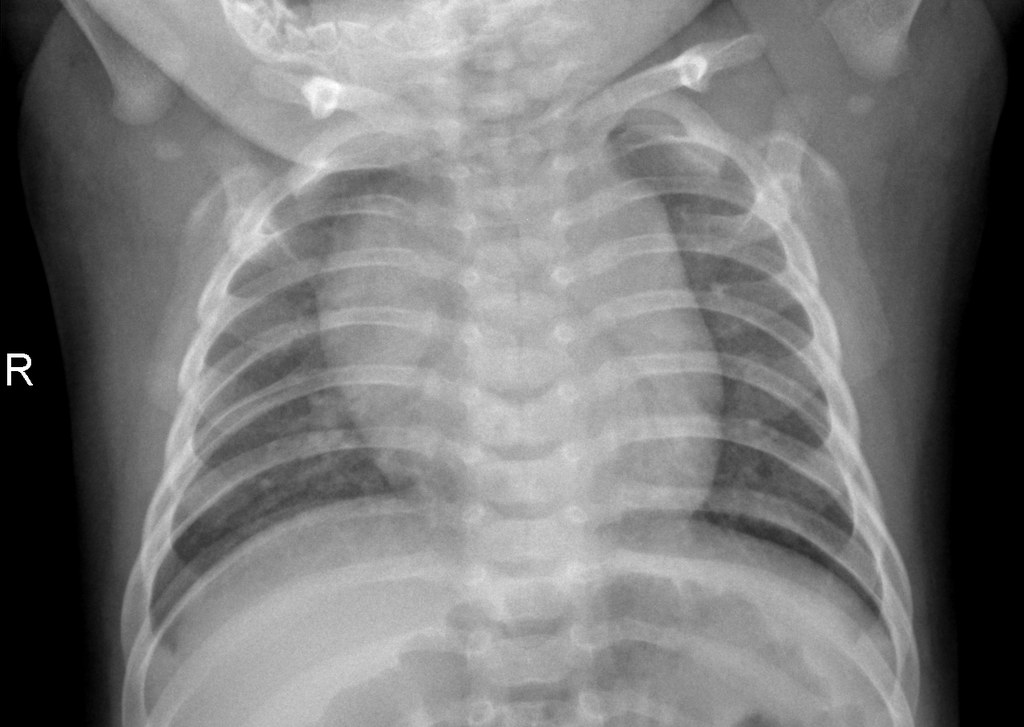 Normal chest X-ray, sample 1