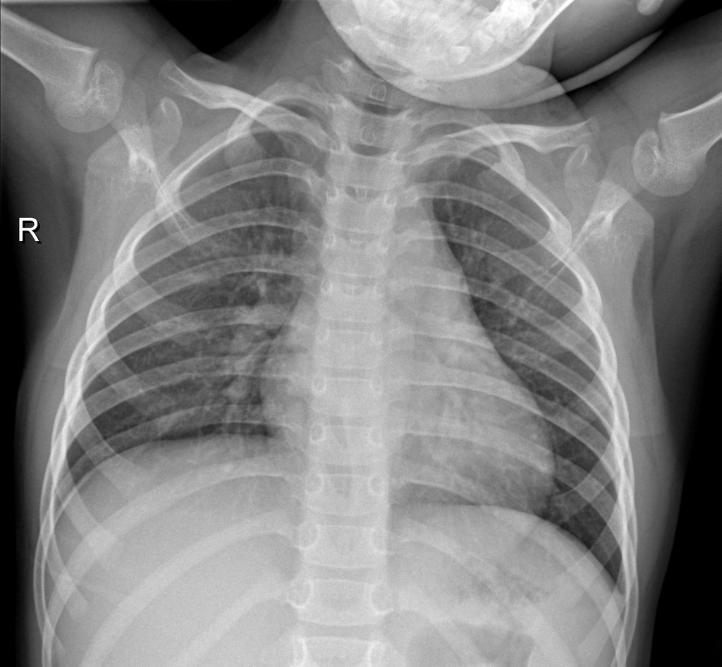 Normal chest X-ray, sample 2