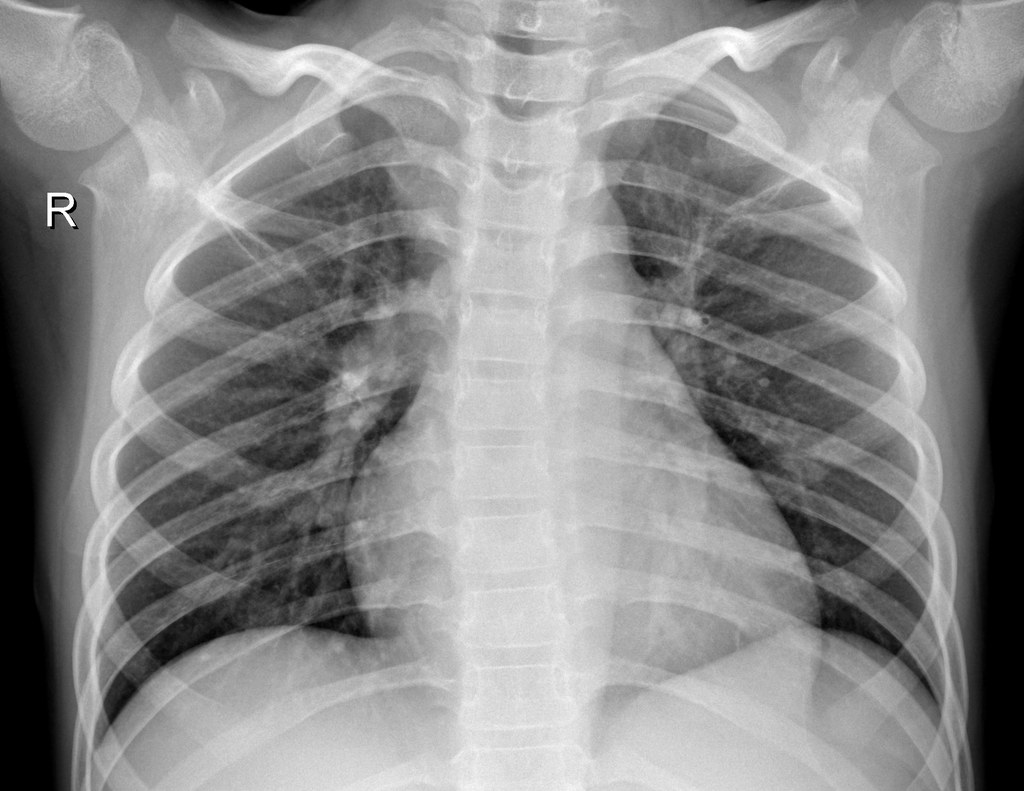 Normal chest X-ray, sample 3