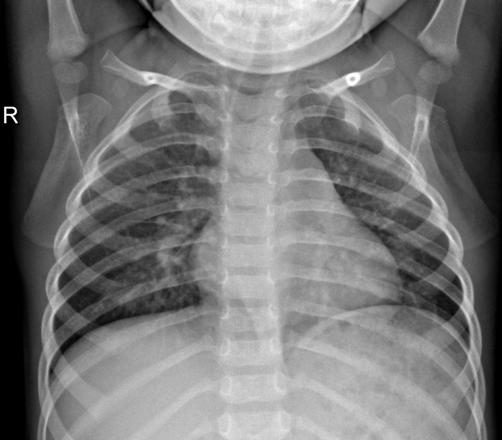 Normal chest X-ray, sample 4