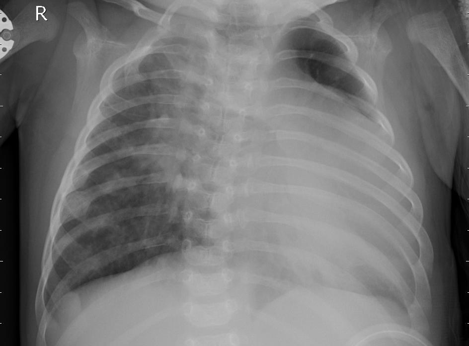 Pneumonia (bacterial) chest X-ray, sample 5