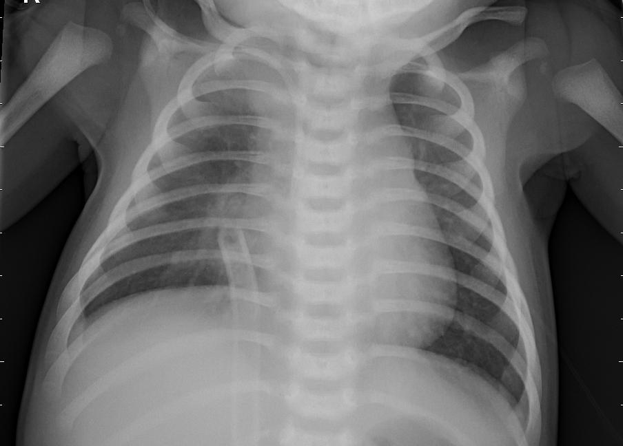Pneumonia (bacterial) chest X-ray, sample 6