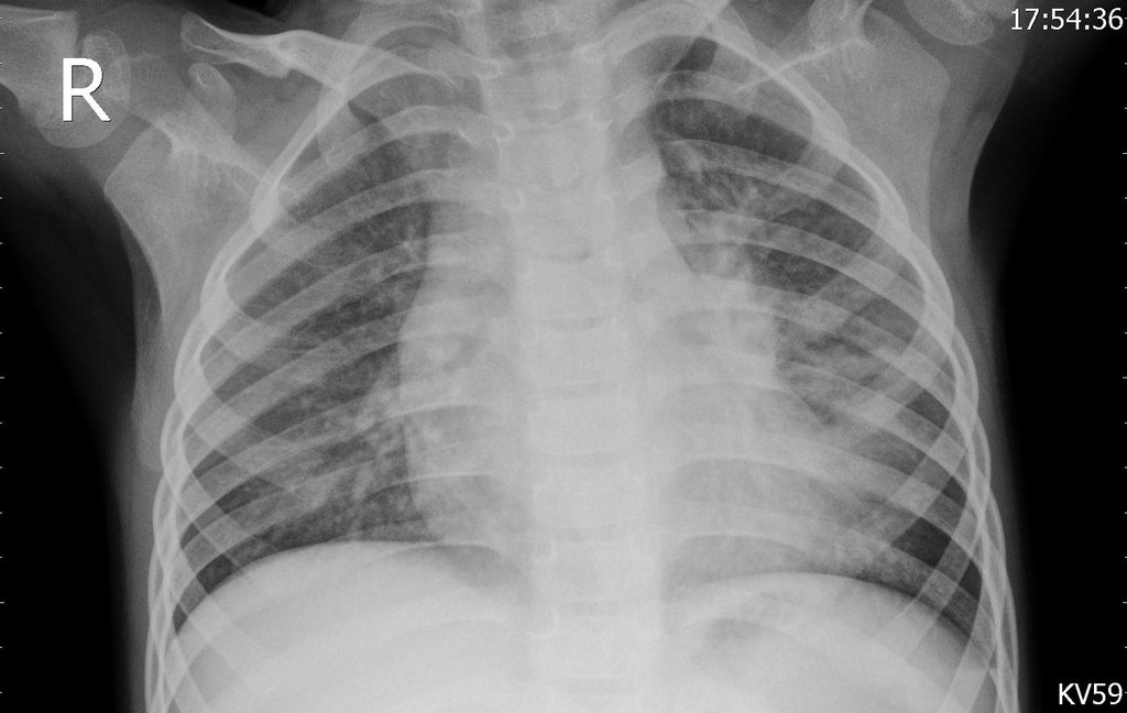 Pneumonia (bacterial) chest X-ray, sample 7
