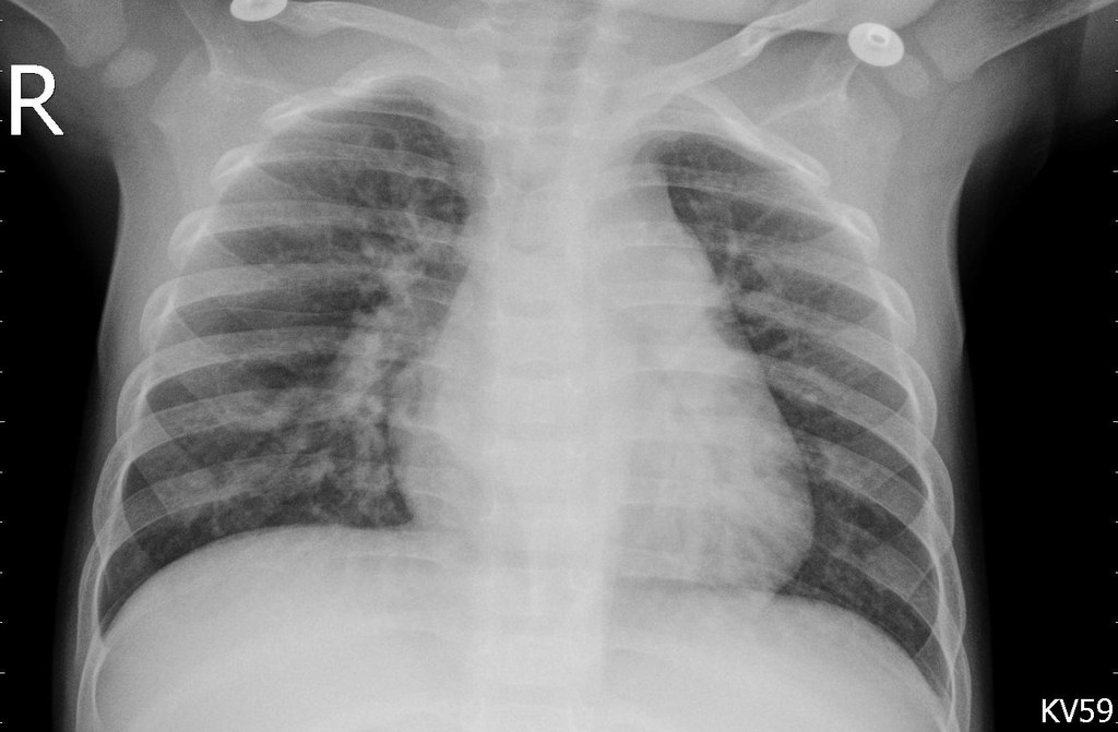 Pneumonia (viral) chest X-ray, sample 8