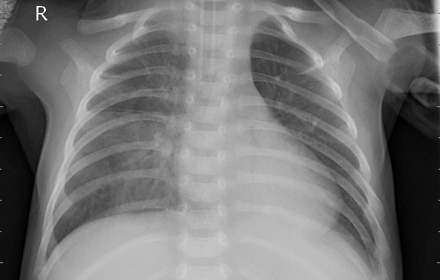 Pneumonia (viral) chest X-ray, sample 9