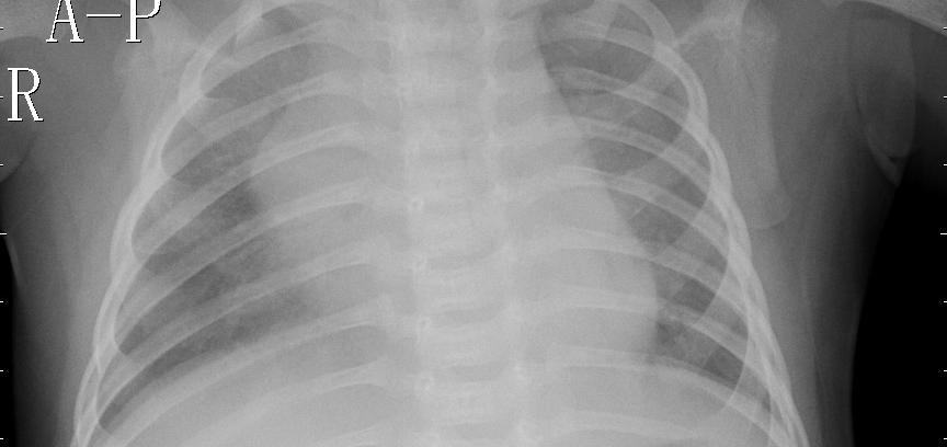 Pneumonia (viral) chest X-ray, sample 10